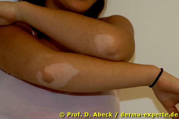 Vitiligo. Symmetrisch im Bereich der Ellenbogen zeigen sich sehr scharf zur umgebenen unbefallenen Haut abgegrenzte weißliche Flecken.
